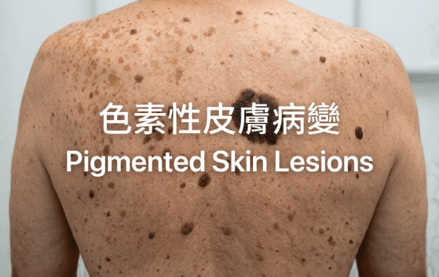 色素性皮膚病變 Pigmented Skin Lesions